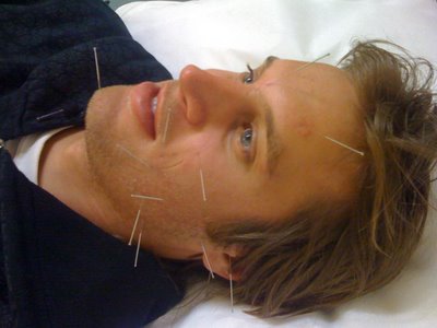 Bells Palsy Acupuncture